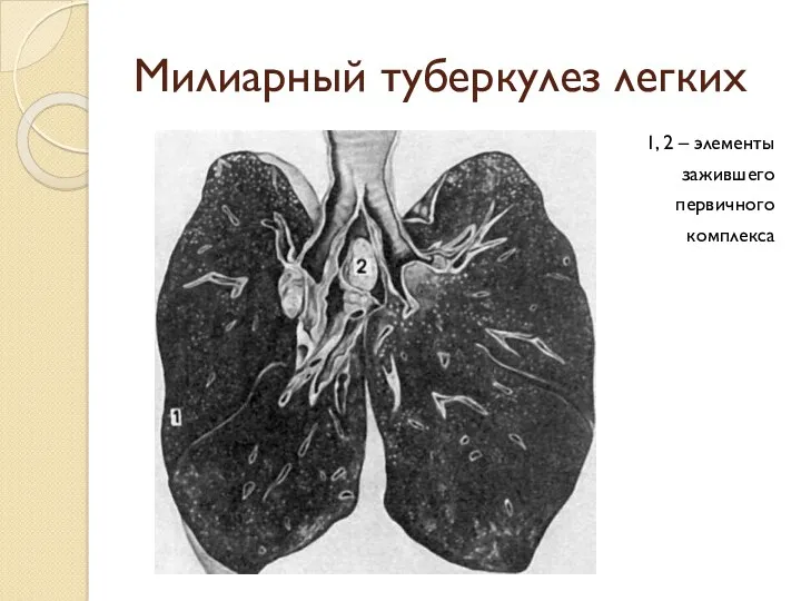 Милиарный туберкулез легких 1, 2 – элементы зажившего первичного комплекса