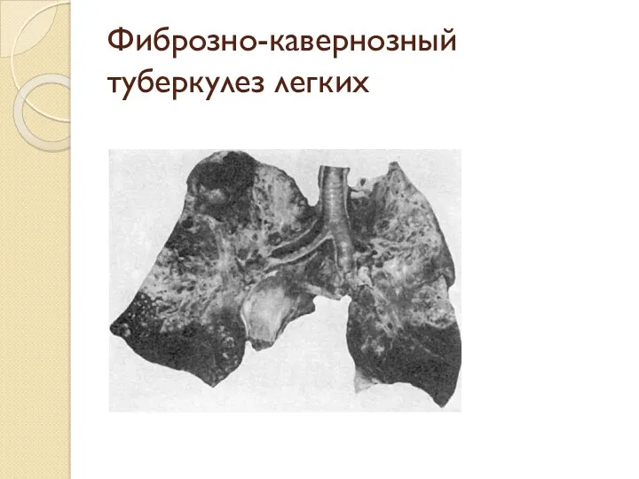 Фиброзно-кавернозный туберкулез легких