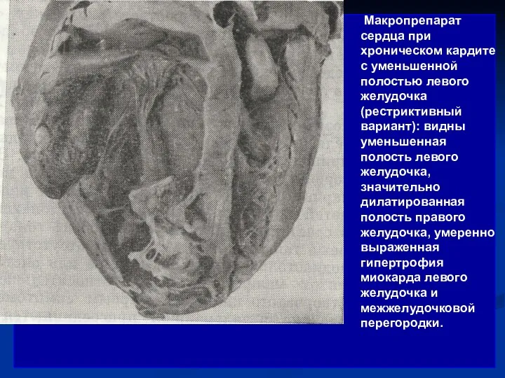 Макропрепарат сердца при хроническом кардите с уменьшенной полостью левого желудочка
