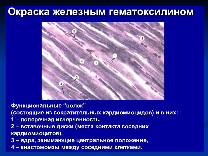 Окраска железным гематоксилином Функциональные “волок” (состоящие из сократительных кардиомиоцидов) и