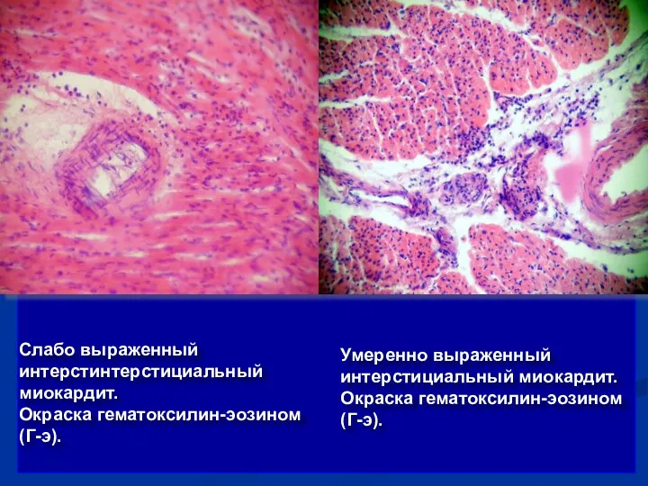 Слабо выраженный интерстинтерстициальный миокардит. Окраска гематоксилин-эозином (Г-э). Умеренно выраженный интерстициальный миокардит. Окраска гематоксилин-эозином (Г-э).