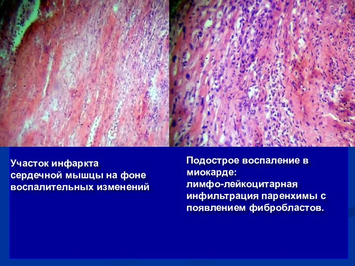 Участок инфаркта сердечной мышцы на фоне воспалительных изменений Подострое воспаление