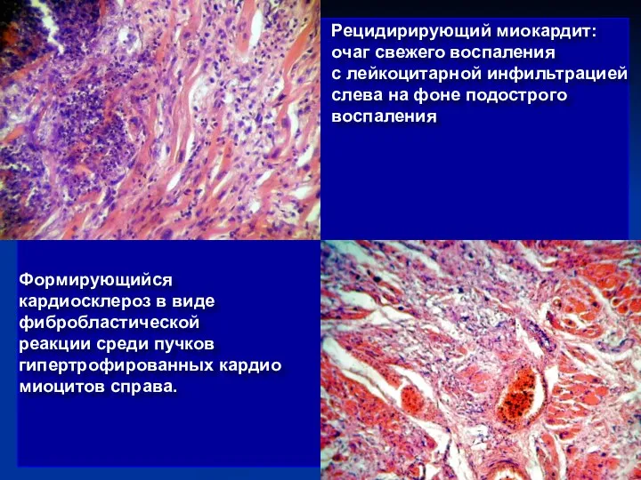 Формирующийся кардиосклероз в виде фибробластической реакции среди пучков гипертрофированных кардио