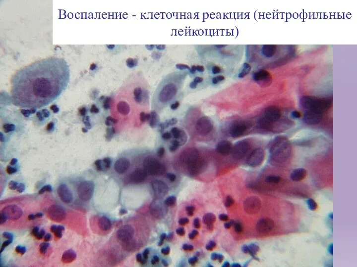Воспаление - клеточная реакция (нейтрофильные лейкоциты)