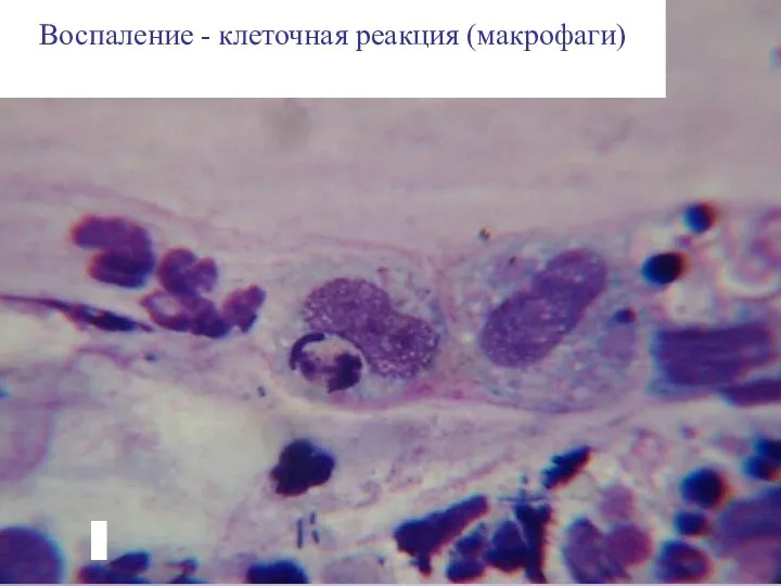 Воспаление - клеточная реакция (макрофаги)