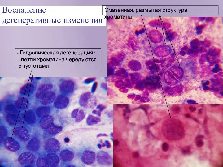 Воспаление – дегенеративные изменения Смазанная, размытая структура хроматина «Гидропическая дегенерация» - петли хроматина чередуются с пустотами