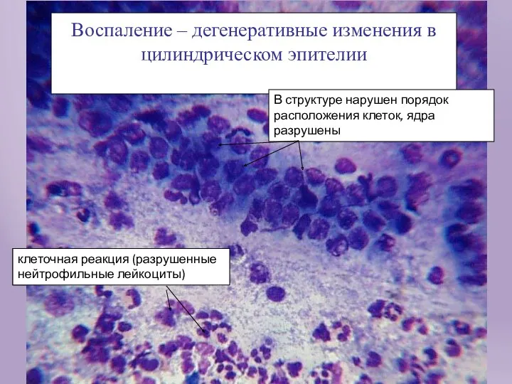 Воспаление – дегенеративные изменения в цилиндрическом эпителии клеточная реакция (разрушенные нейтрофильные лейкоциты) В