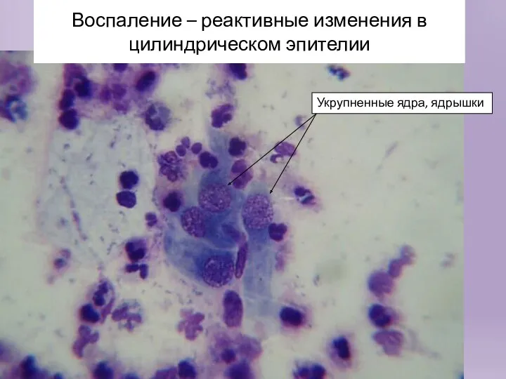 Воспаление – реактивные изменения в цилиндрическом эпителии Укрупненные ядра, ядрышки