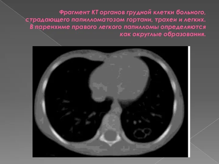 Фрагмент КТ органов грудной клетки больного, страдающего папилломатозом гортани, трахеи и легких. В