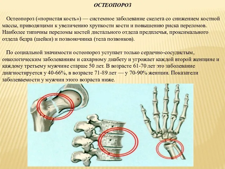 ОСТЕОПОРОЗ Остеопороз («пористая кость») — системное заболевание скелета со снижением