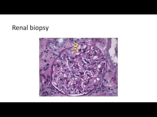 Renal biopsy