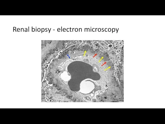 Renal biopsy - electron microscopy