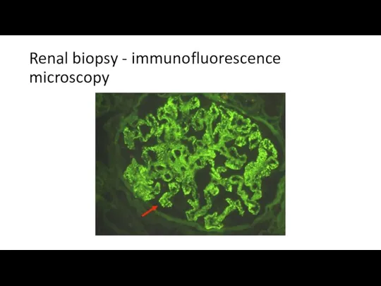 Renal biopsy - immunofluorescence microscopy