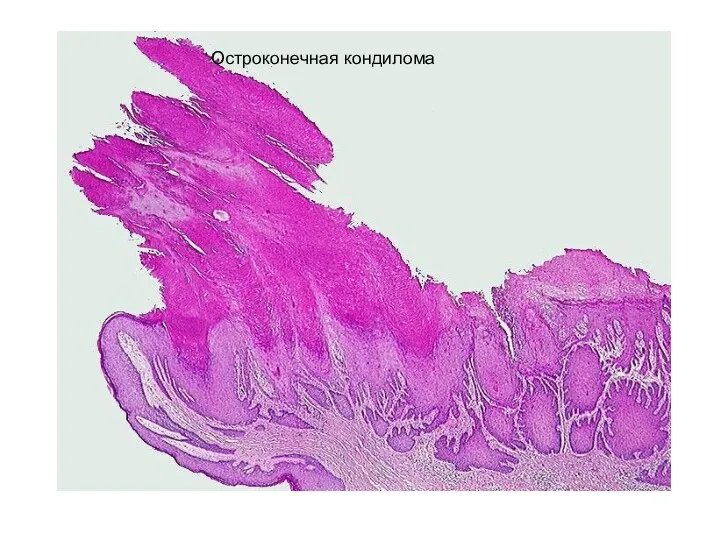 Остроконечная кондилома