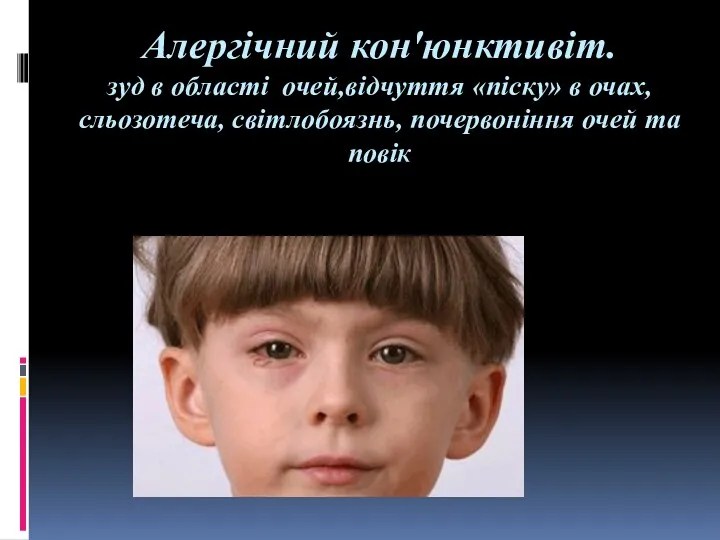 Алергічний кон'юнктивіт. зуд в області очей,відчуття «піску» в очах, сльозотеча, світлобоязнь, почервоніння очей та повік