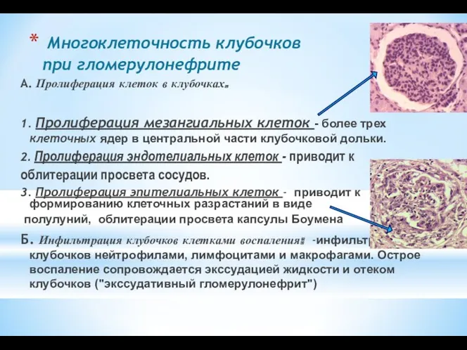 Многоклеточность клубочков при гломерулонефрите А. Пролиферация клеток в клубочках. 1. Пролиферация мезангиальных клеток