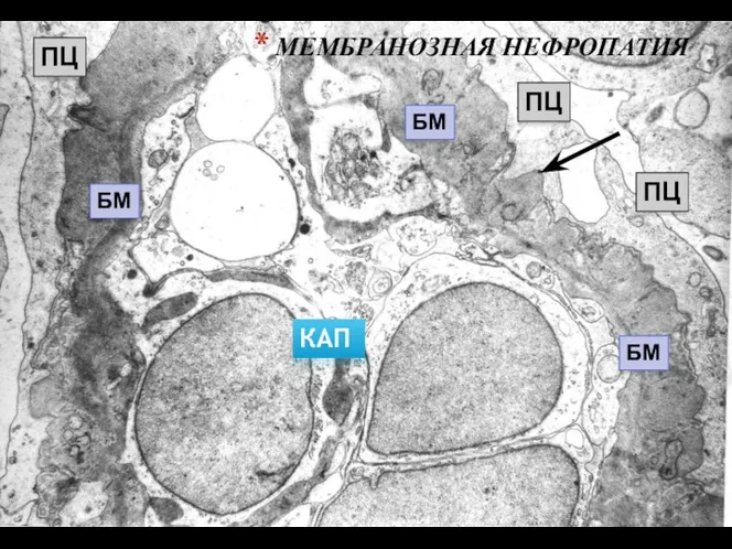 МЕМБРАНОЗНАЯ НЕФРОПАТИЯ ПЦ ПЦ ПЦ БМ БМ БМ КАП