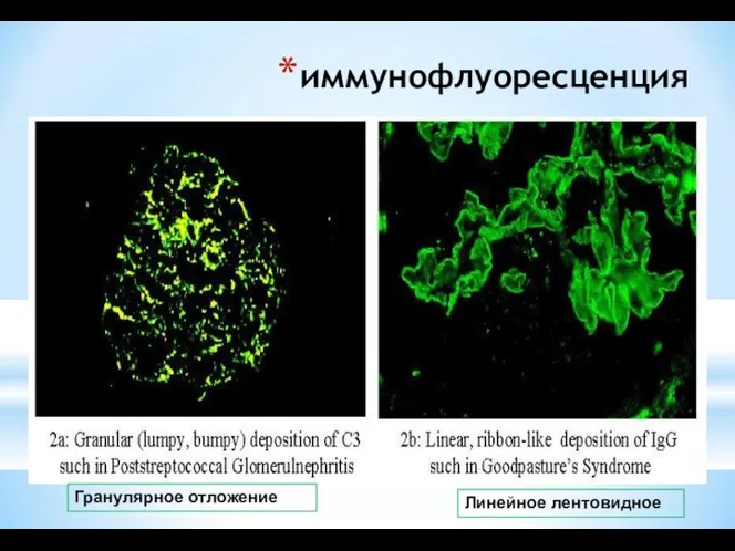 иммунофлуоресценция Линейное лентовидное Гранулярное отложение