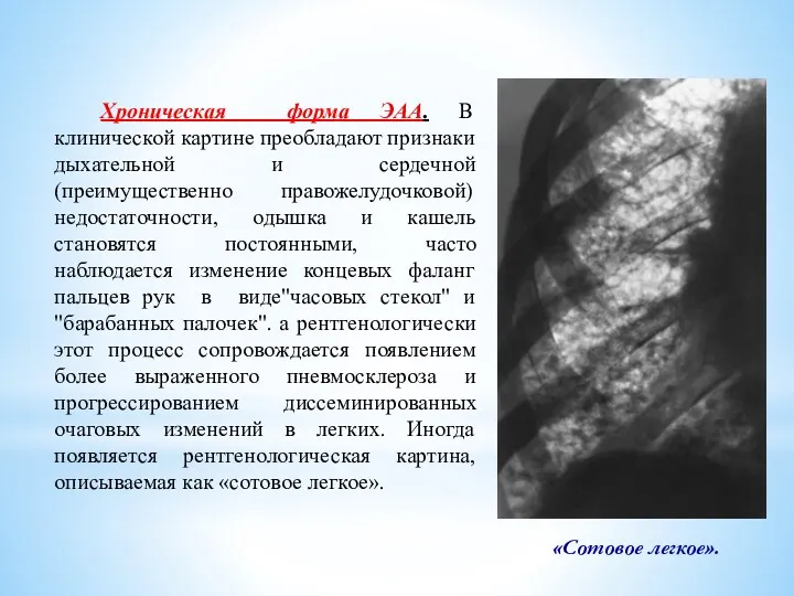 Хроническая форма ЭАА. В клинической картине преобладают признаки дыхательной и