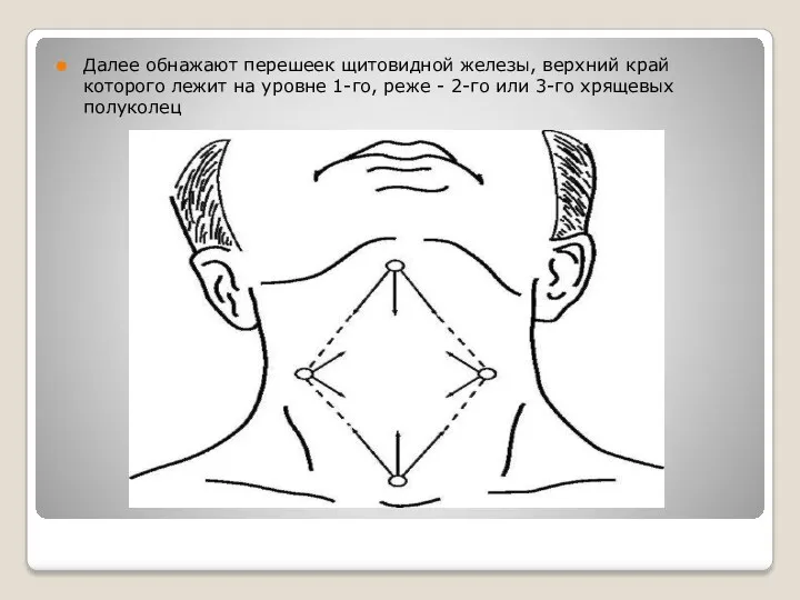 Далее обнажают перешеек щитовидной железы, верхний край которого лежит на