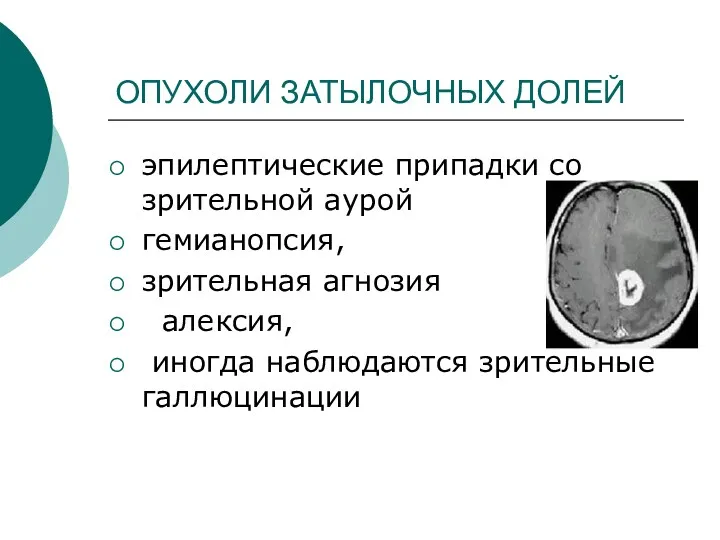 ОПУХОЛИ ЗАТЫЛОЧНЫХ ДОЛЕЙ эпилептические припадки со зрительной аурой гемианопсия, зрительная агнозия алексия, иногда наблюдаются зрительные галлюцинации