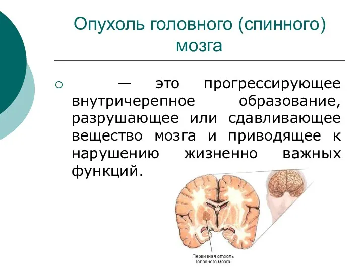 Опухоль головного (спинного) мозга — это прогрессирующее внутричерепное образование, разрушающее или сдавливающее вещество