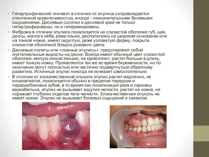 Гипертрофический гингивит в отличии от эпулиса сопровождается спонтанной кровоточивостью, иногда