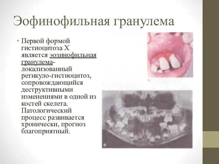 Эофинофильная гранулема Первой формой гистиоцитоза X является эозинофильная гранулема-локализованный ретикуло-гистиоцитоз,