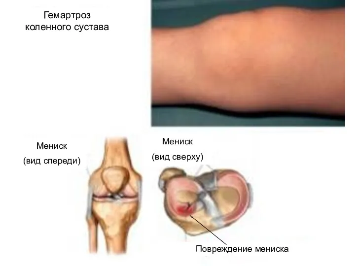 Гемартроз коленного сустава Мениск (вид сверху) Мениск (вид спереди) Повреждение мениска