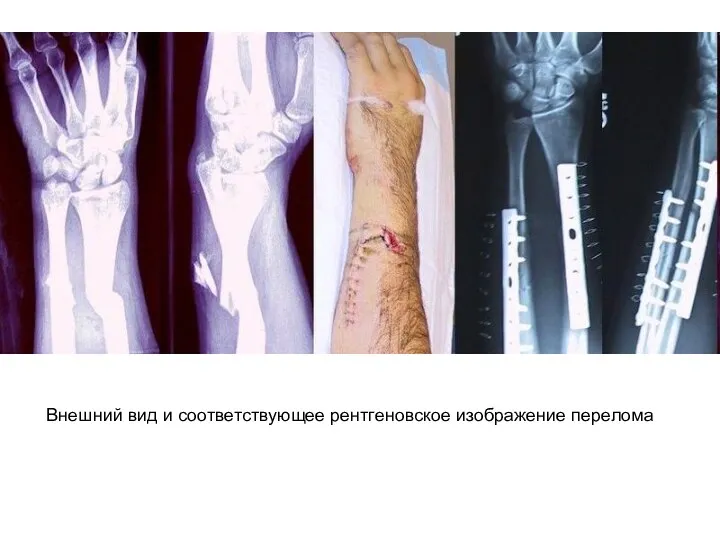 Внешний вид и соответствующее рентгеновское изображение перелома