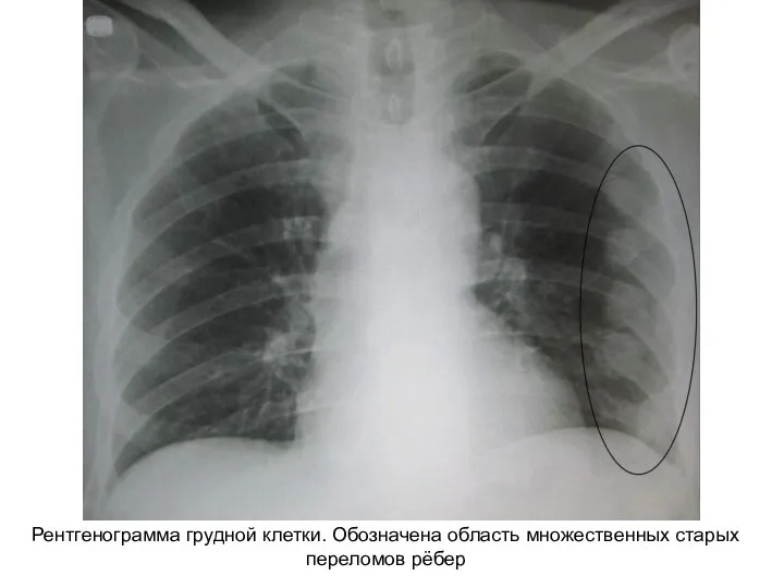 Рентгенограмма грудной клетки. Обозначена область множественных старых переломов рёбер