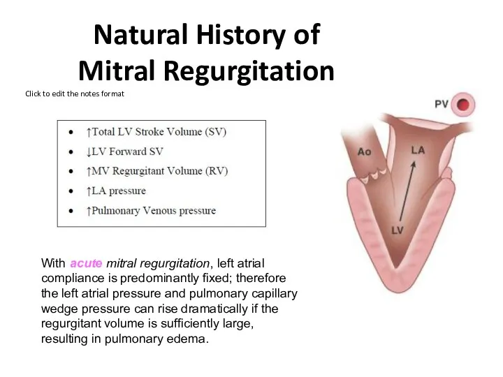 Natural History of Mitral Regurgitation With acute mitral regurgitation, left atrial compliance is