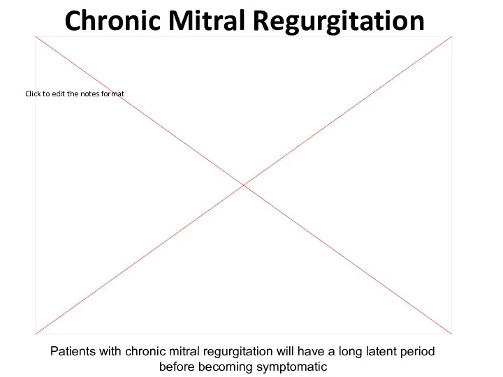 Chronic Mitral Regurgitation Patients with chronic mitral regurgitation will have a long latent