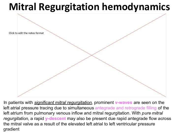 Mitral Regurgitation hemodynamics In patients with significant mitral regurgitation, prominent v-waves are seen