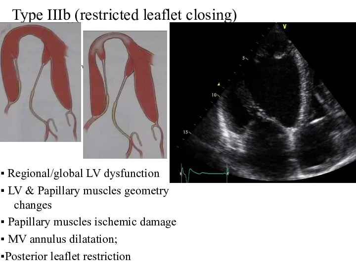 Type IIIb (restricted leaflet closing) ▪ Regional/global LV dysfunction ▪ LV & Papillary