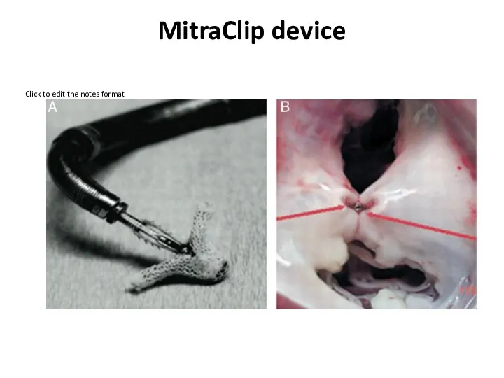 MitraClip device