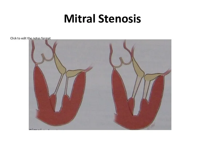 Mitral Stenosis