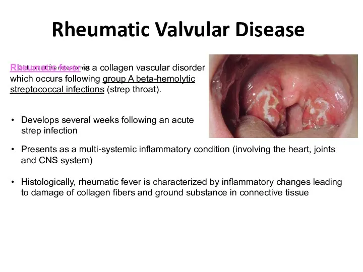 Rheumatic Valvular Disease Rheumatic fever is a collagen vascular disorder which occurs following