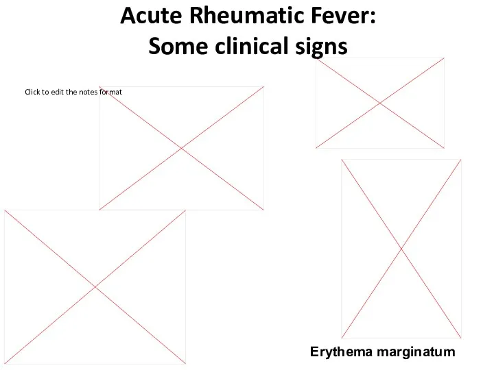 Acute Rheumatic Fever: Some clinical signs Erythema marginatum