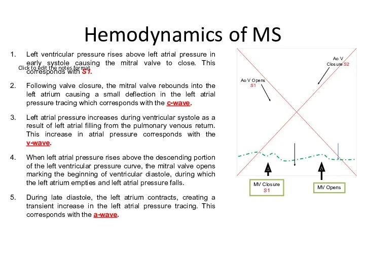 Hemodynamics of MS Left ventricular pressure rises above left atrial pressure in early