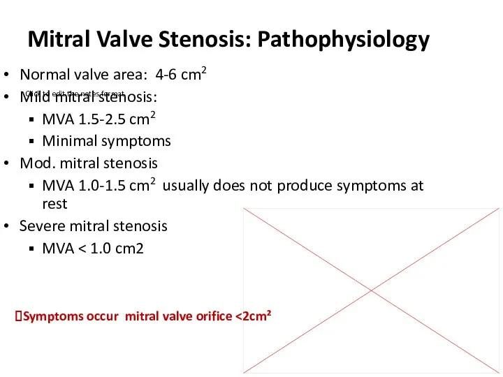 Mitral Valve Stenosis: Pathophysiology Normal valve area: 4-6 cm2 Mild mitral stenosis: MVA