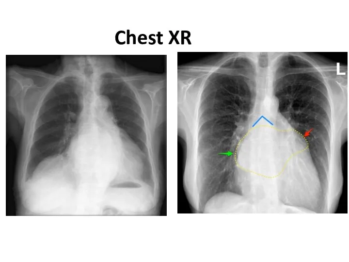 Chest XR