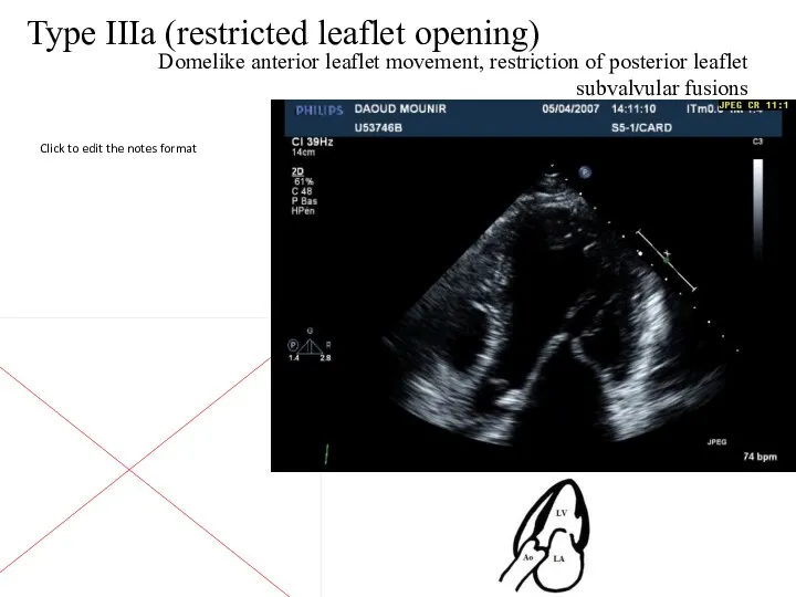 Type IIIa (restricted leaflet opening) Domelike anterior leaflet movement, restriction of posterior leaflet subvalvular fusions