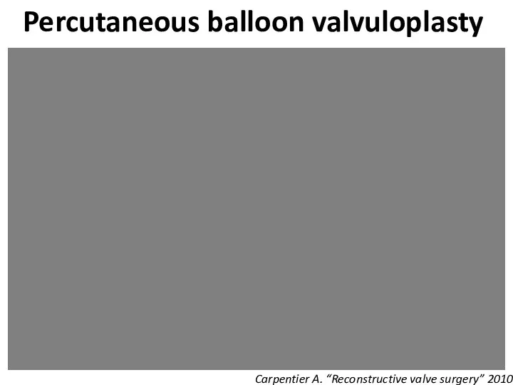 Percutaneous balloon valvuloplasty Carpentier A. “Reconstructive valve surgery” 2010