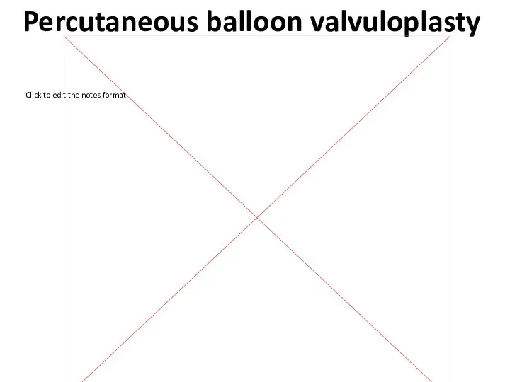 Percutaneous balloon valvuloplasty