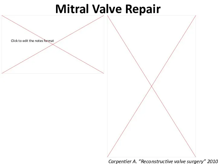 Mitral Valve Repair Carpentier A. “Reconstructive valve surgery” 2010
