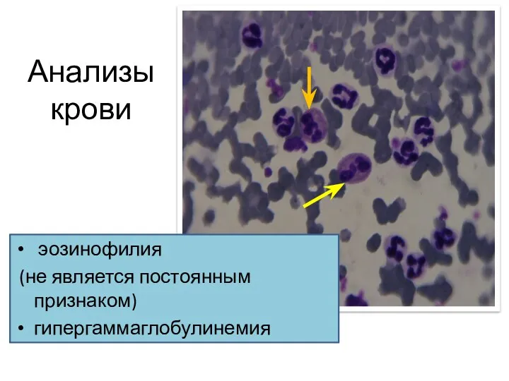 Анализы крови эозинофилия (не является постоянным признаком) гипергаммаглобулинемия