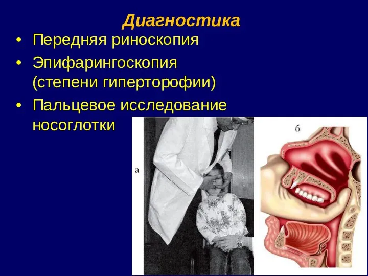 Диагностика Передняя риноскопия Эпифарингоскопия (степени гиперторофии) Пальцевое исследование носоглотки