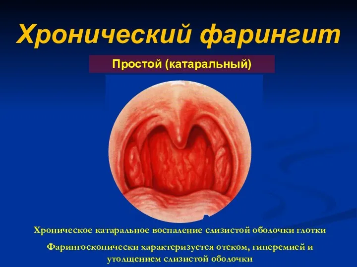 Хронический фарингит Простой (катаральный) Хроническое катаральное воспаление слизистой оболочки глотки