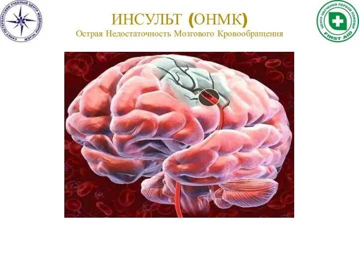 ИНСУЛЬТ (ОНМК) Острая Недостаточность Мозгового Кровообращения